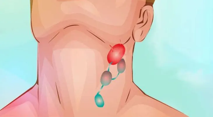 ¿Cuáles son las causas de linfoma?. Tratamiento y prevención