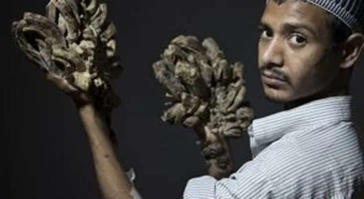 El hombre árbol supera con éxito primera operación