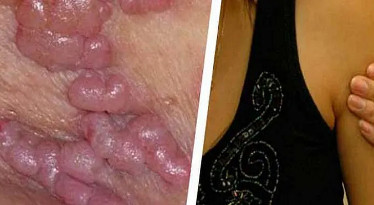 Nueva enfermedad: Más mortal para las mujeres que el sida, ni los preservativos te salvan!!!