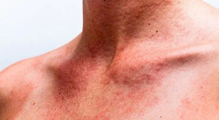 Con estas mascarillas podrás aclarar la piel en cualquier parte del cuerpo