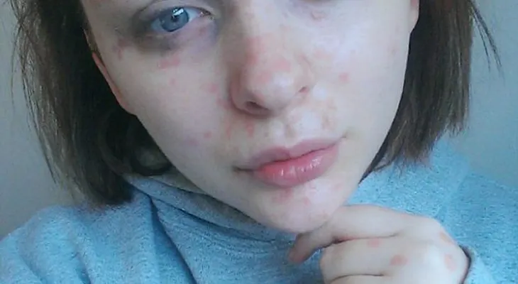 Un hombre abandonó a su novia que sufre de una rara enfermedad, cuando la vio sin maquillaje