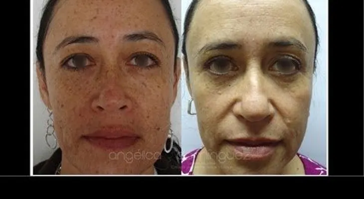 Tratamientos para manchas en la cara, axilas...(Video) 