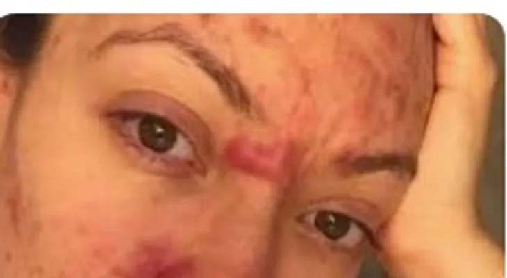 High sugar consumption causes acne