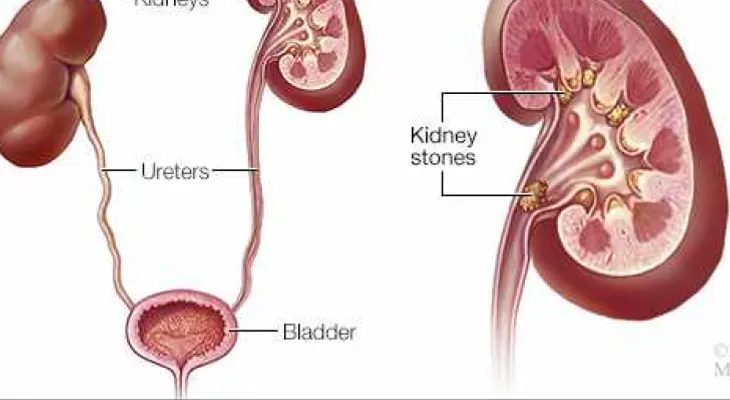 ¿Cómo deciden los médicos el mejor tratamiento para los cálculos renales? 
