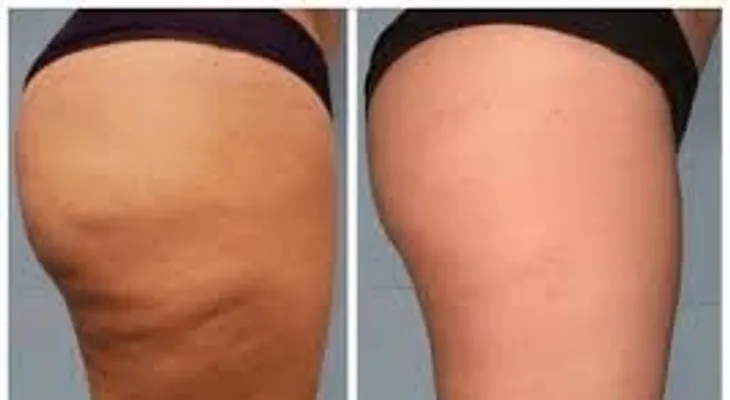 Elimina la celulitis solo con orégano y aceite de oliva 