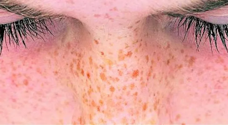 Las pecas: naturalidad y rebeldía