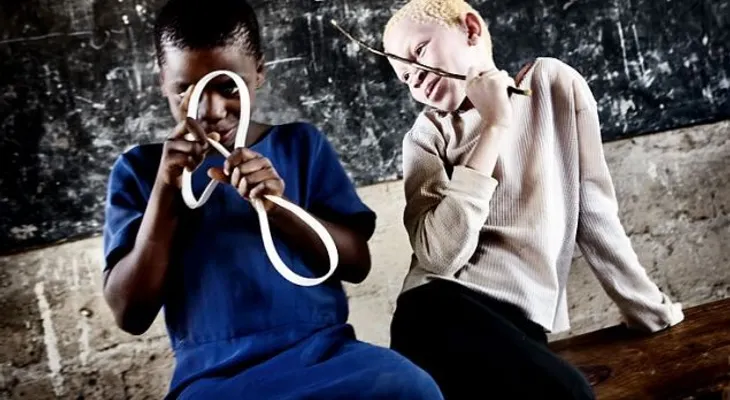 El infierno de ser albino en África