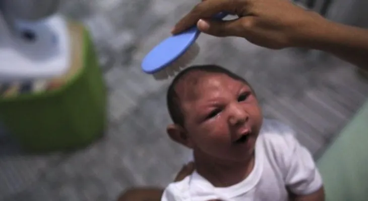 Dirección de epidemiología registra 28 casos de microcefalia asociados al virus del zika