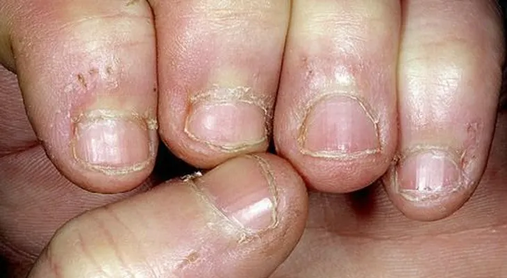 Entérate: Cómo eliminar el hongo de las uñas para siempre 