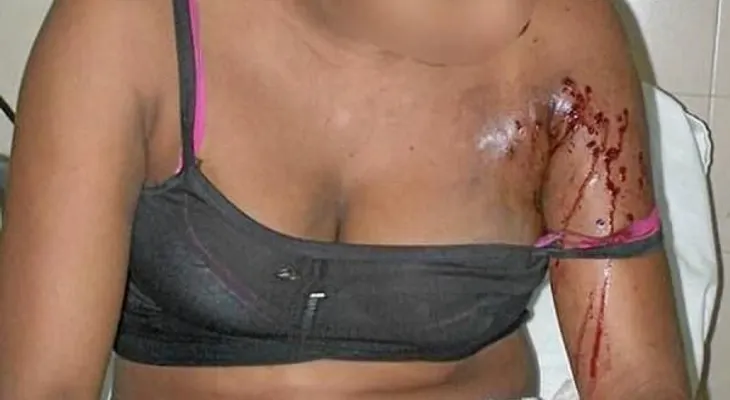 Mujer se hiere para acusar a su marido en La Romana