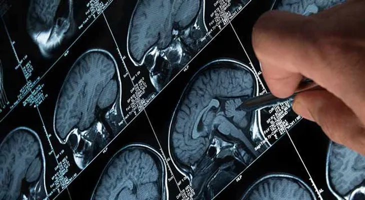 Principales características clínicas acromegalia y las novedades terapéuticas