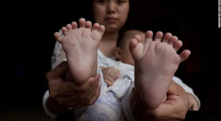 Niño chino nace con 31 dedos; sus padres buscan someterlo a cirugía