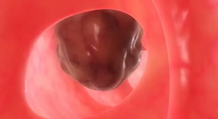 El microbioma del cáncer de colon favorece la aparición de metástasis