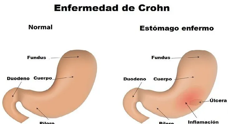 Diferencia entre intolerancia y alergia a los alimentos
