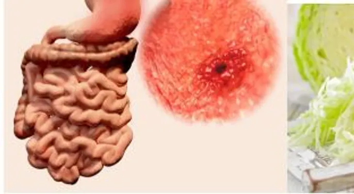 Las úlceras gastricas: 5 jugos naturales que te recubre el estómago