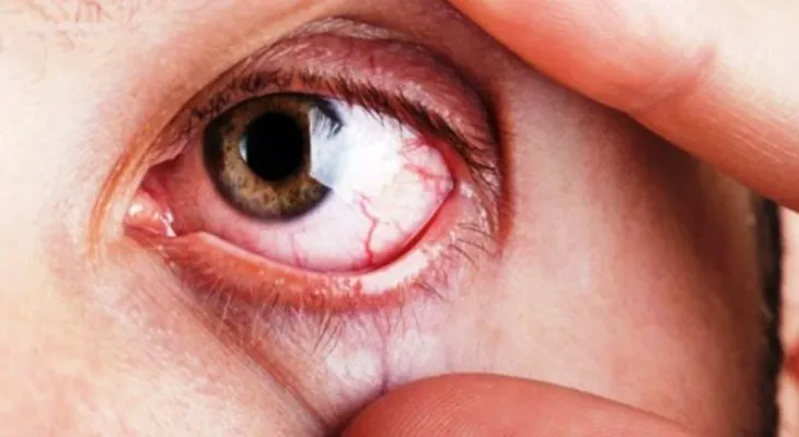 El glaucoma afectará 80 millones de personas y es una enfermedad difícil de detectar 