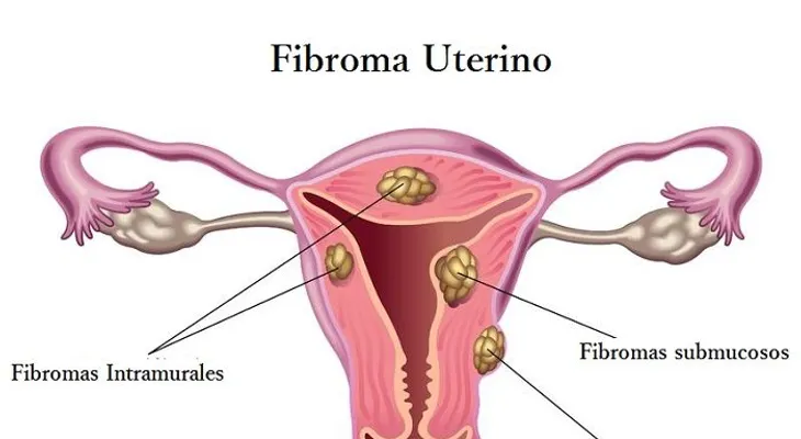 Los fibromas y cómo tratarlos