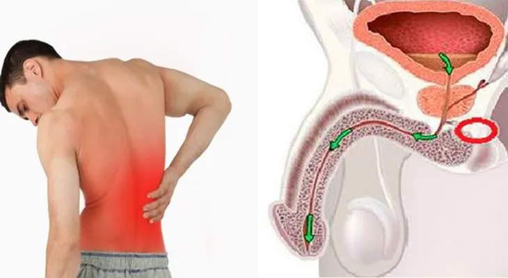 10 síntomas tempranos de cáncer en la próstata que ningún hombre debe ignorar!