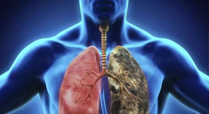 Un nuevo tratamiento aumenta la supervivencia en pacientes con cáncer de pulmón