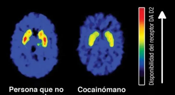 Los efectos en el cerebro del consumo de marihuana