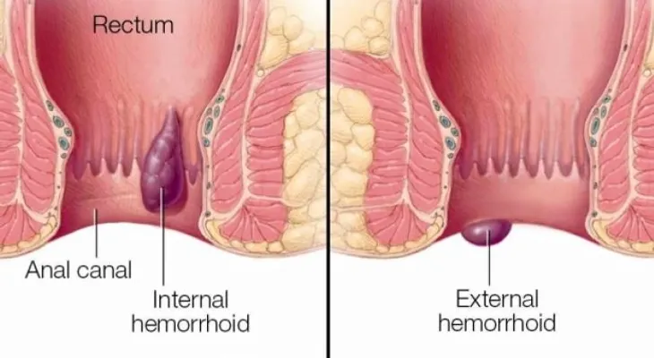 Intentar medidas de autocuidado para aliviar las hemorroides