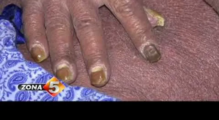 Atienden dominicano con piel de culebra; sufre de psoriasis