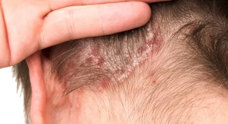 La psoriasis: Inflamación de la piel y articulaciones de carácter crónico; evita los largos baños o agua muy caliente