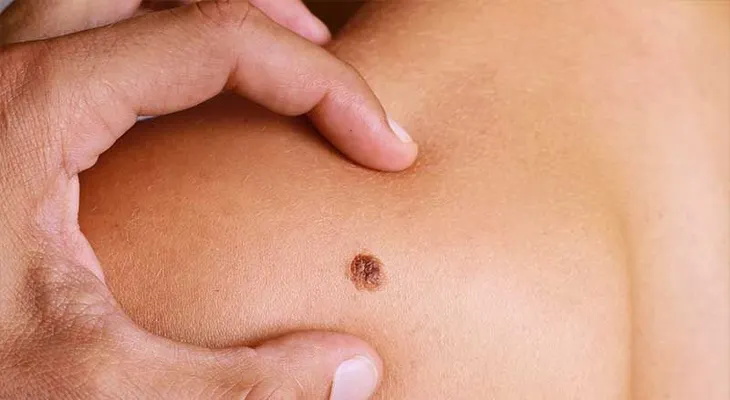 Cómo saber si tu lunar es normal o tiene señales de riesgo 