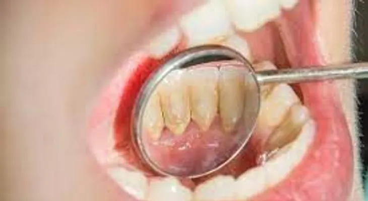 Te diremos un remedio para eliminar el sarro de tus dientes