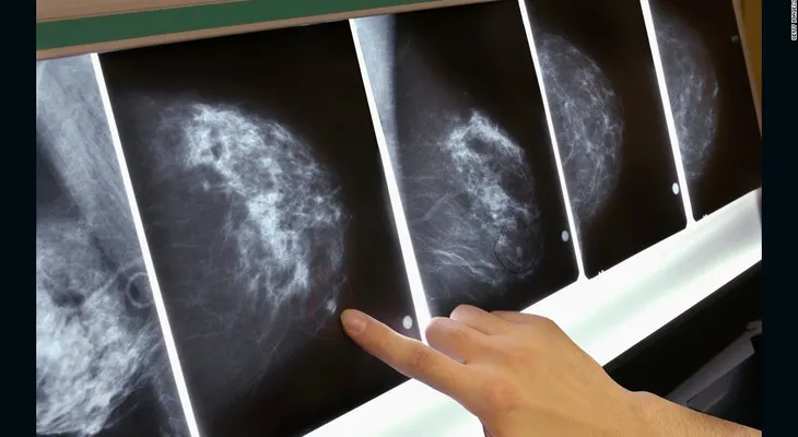 Hasta 270 mujeres pueden haber muerto por error en plan de detección de cáncer de mama en Inglaterra