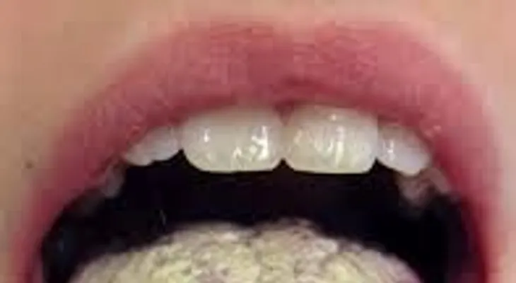 La candidiasis y sus peligros 