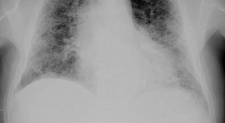 Enfermedades raras: fibrosis pulmonar idiopática (FPI)
