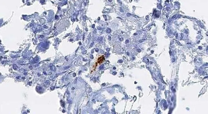 Demuestran que el alzhéimer se transmite entre humanos