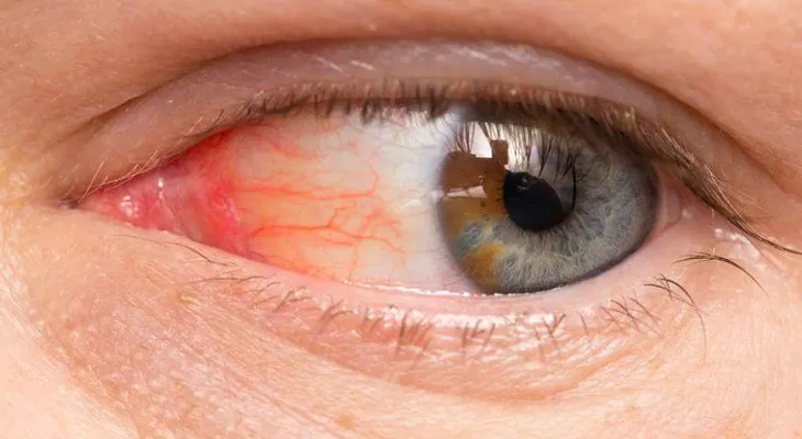 Remedios caseros para las infecciones en los ojos