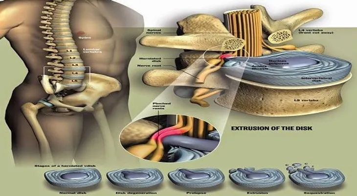 ¿Cómo curar la hernia de disco, sin una cirugía?