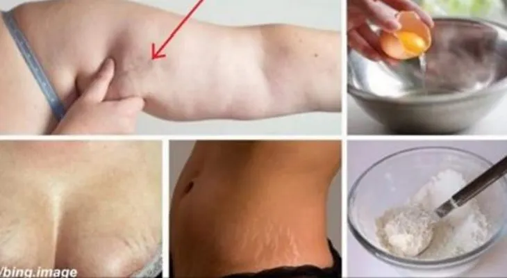 Las mujeres están locas con este remedio que elimina la flacidez, celulitis y estrías