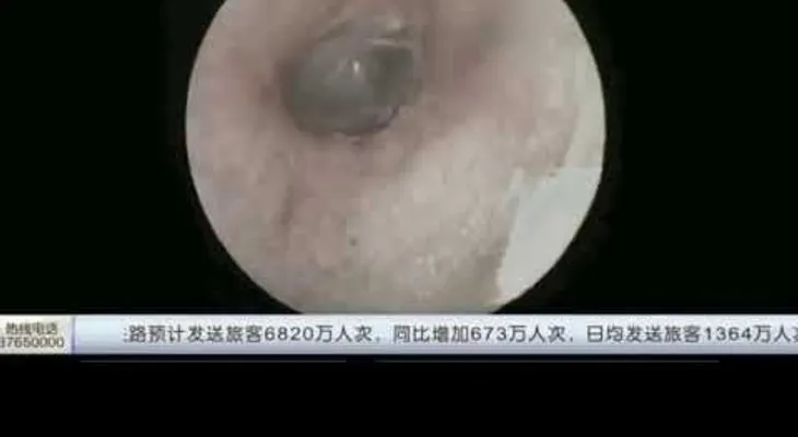 IMAGENES PODRIAN SER SENSIBLES: Una araña tejía su tela dentro del oído de un hombre