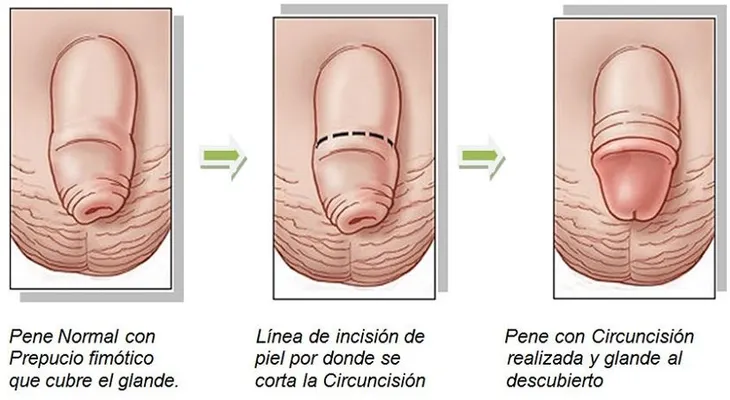 Los beneficios de la circuncisión
