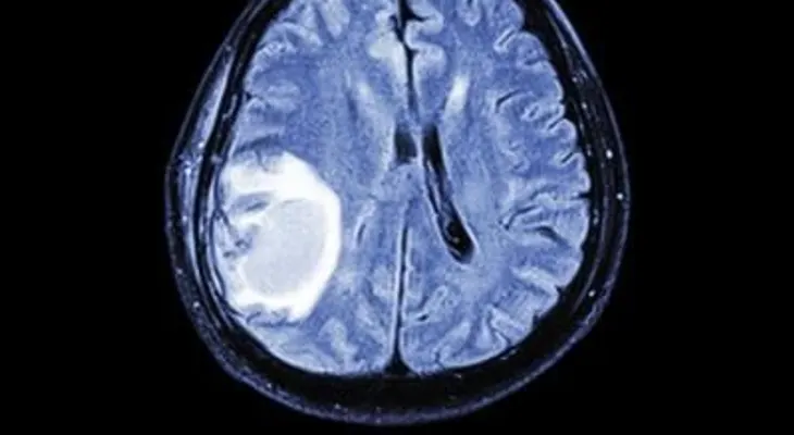Descubren forma para atacar metástasis cerebrales