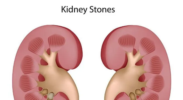 10 remedios para piedras en los riñones 