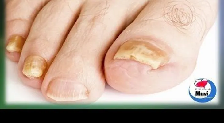 Un tratamiento efizca para curar los hongos en las uñas de los pies y manos 