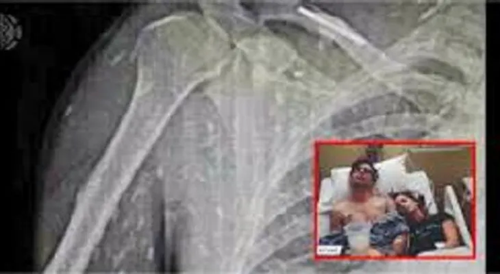 Este hombre terminó su cuerpo plagado de gusanos...por un descuido que pocos saben