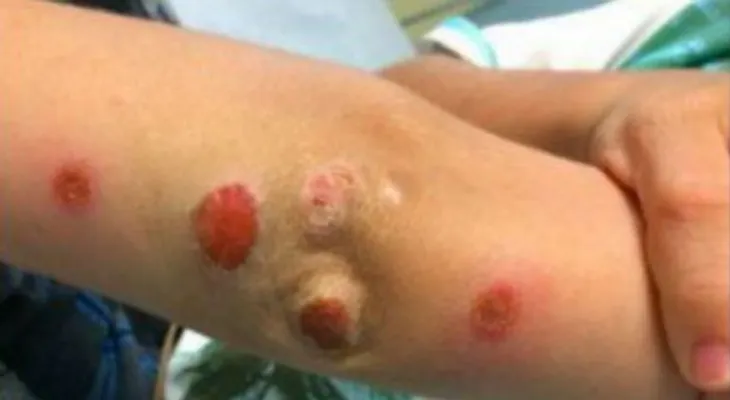Notó que su hijo llegó de una fiesta con estas marcas en su brazo; no creerás lo que dijo el doctor