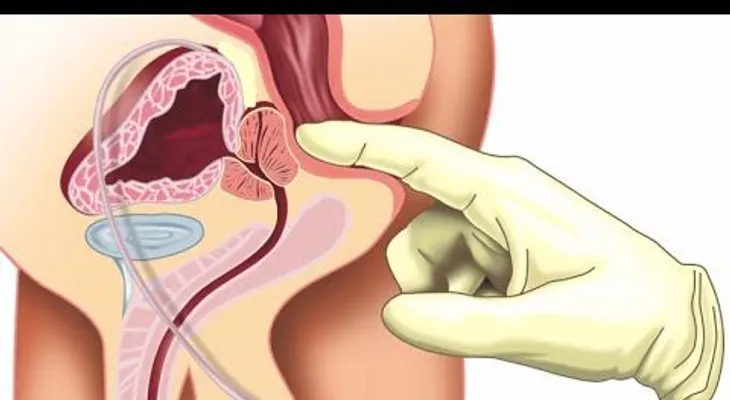 ¿Qué es la prostatitis? (VIDEO)