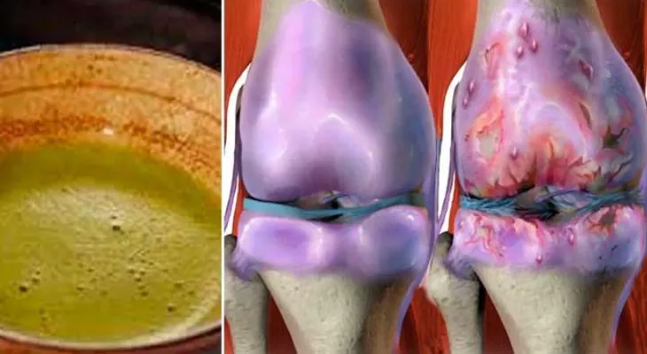 Esta fórmula tiene locos a todo el mundo!! cura tus rodillas, restituye tus huesos y tus articulaciones en seguida.