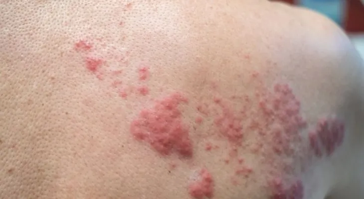 El estrés puede activar la culebrilla o herpes zóster y afectar seriamente la vista