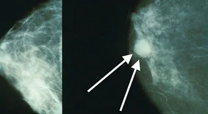 Si tiene cáncer o conoce a quien que lo tiene...lee esto de inmediato y compartelo