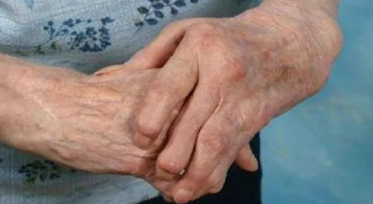 Artritis Psoriásica: Enfermedad de la piel que afecta articulaciones