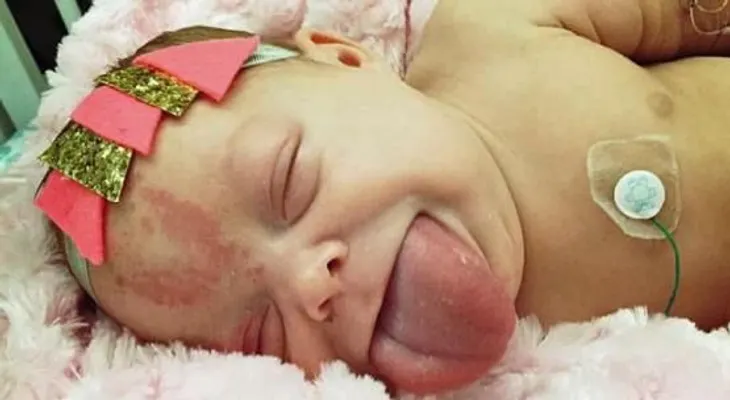 Una bebé con lengua del tamaño de un adulto ahora puede respirar y sonreír con normalidad 
