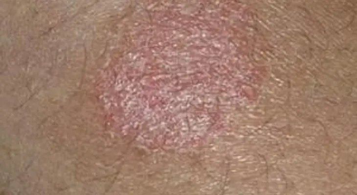 Cómo tratar el eczema con pasta de nuez moscada  